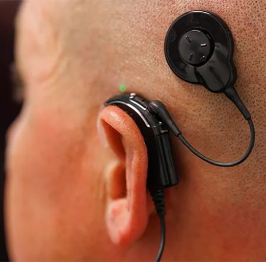 Cochlear-Implant