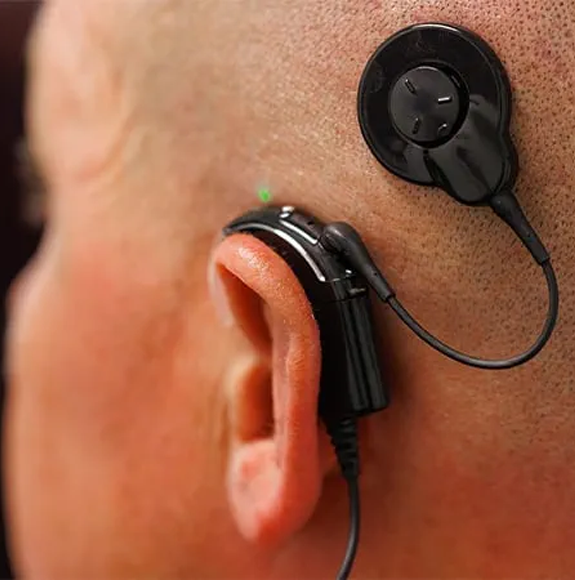 Cochlear-Implant