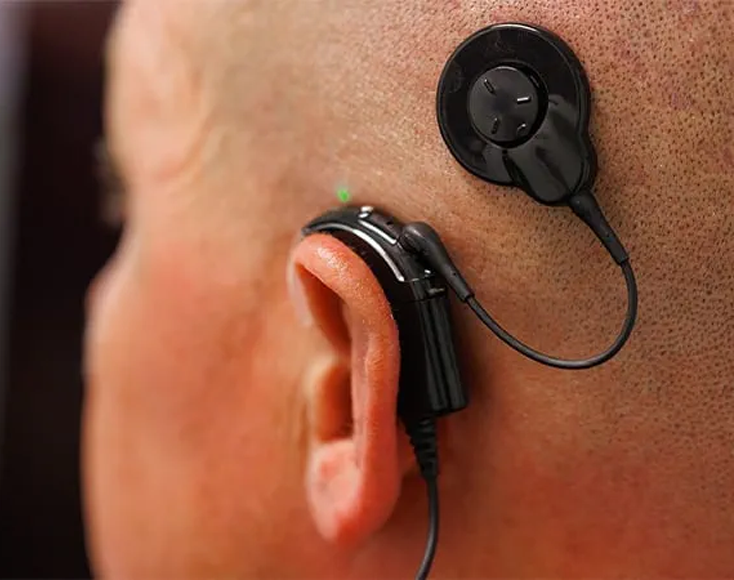 Cochlear-Implant